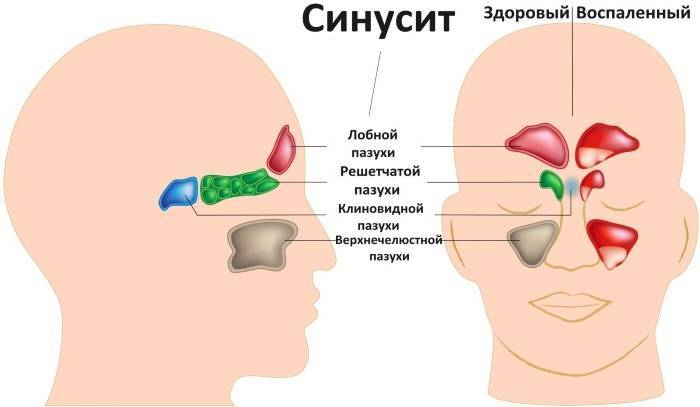 Лечение заложенности носа у детей с помощью народных средств