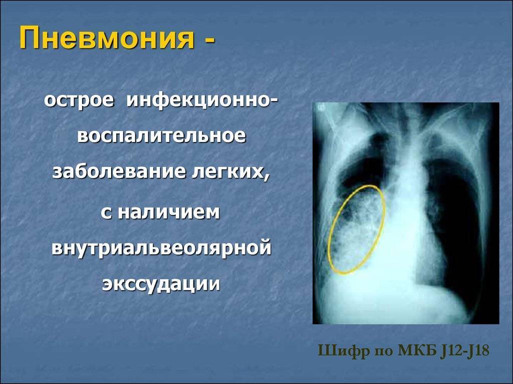 Симптомы и лечение стафилококковой пневмонии