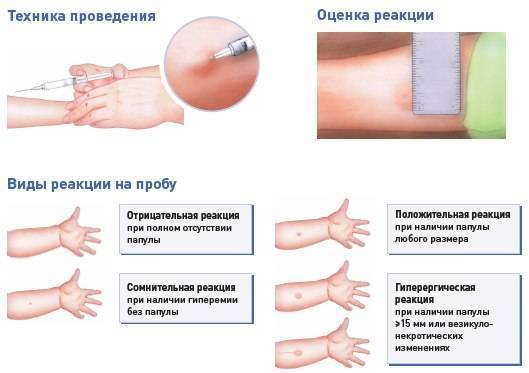 Как избежать температуры после манту у детей и взрослых?
