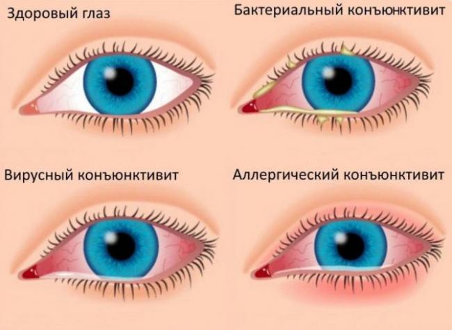 Как лечить хронический конъюнктивит у детей?