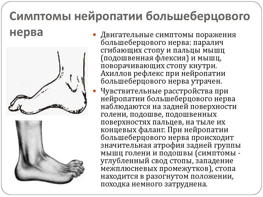 Лечение нейропатии малоберцового нерва народными средствами: лфк при поражении болезнью