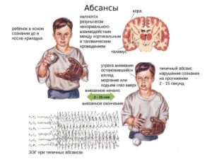 Виды эпилепсии