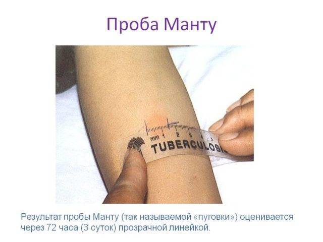 Какой должна быть реакция на пробу манту