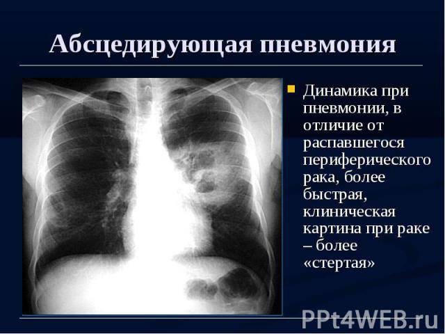 Абсцесс легкого: симптоматика, формы, диагностика и лечение