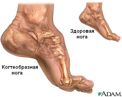 Невральная амиотрофия шарко-мари (стр. 1 из 2)