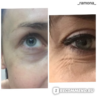 Что лучше: ботокс или диспорт, в чем разница