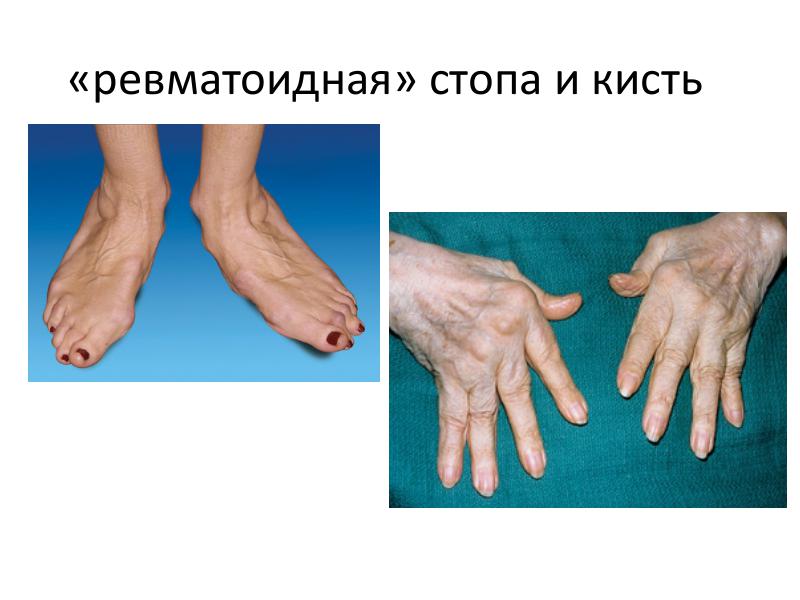 Ревматоидный артрит - симптомы, лечение, диагностика у взрослых и детей