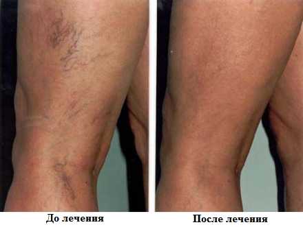 Лечение купероза лазером, удаление сосудистых звездочек, лазерное удаление сосудов на лице и теле, удаление капилляров лазером