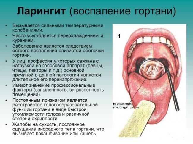 Лечение острого ларингита