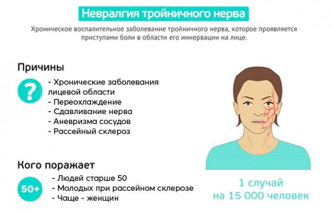 Невралгия тройничного нерва: симптомы и лечение