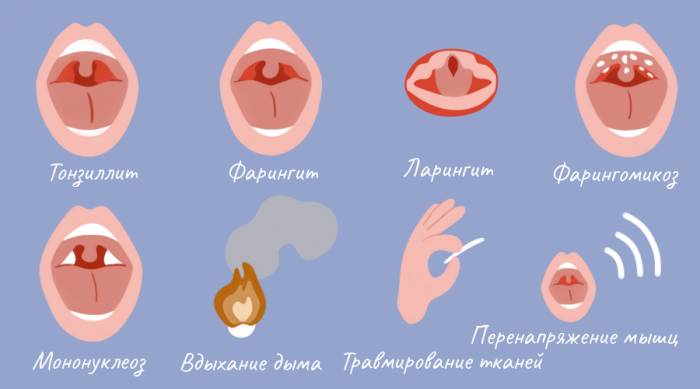 Боль в горле при глотании с одной стороны без кашля