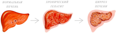 Хронический гепатит с очистка печени