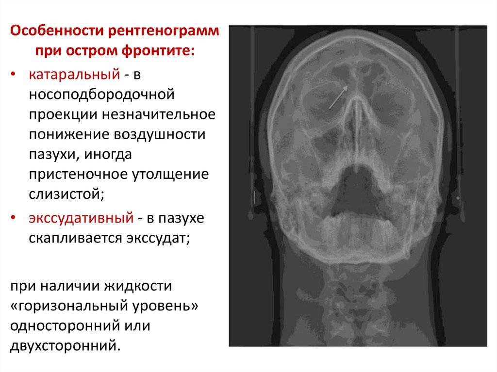 Всё об остром фронтите – признаки, лечение, осложнения и последствия