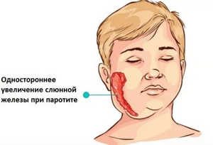 Симптомы и лечение паротита у детей