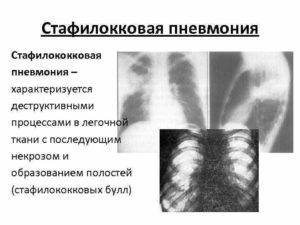 Стафилококковая пневмония: причины, симптомы, лечение