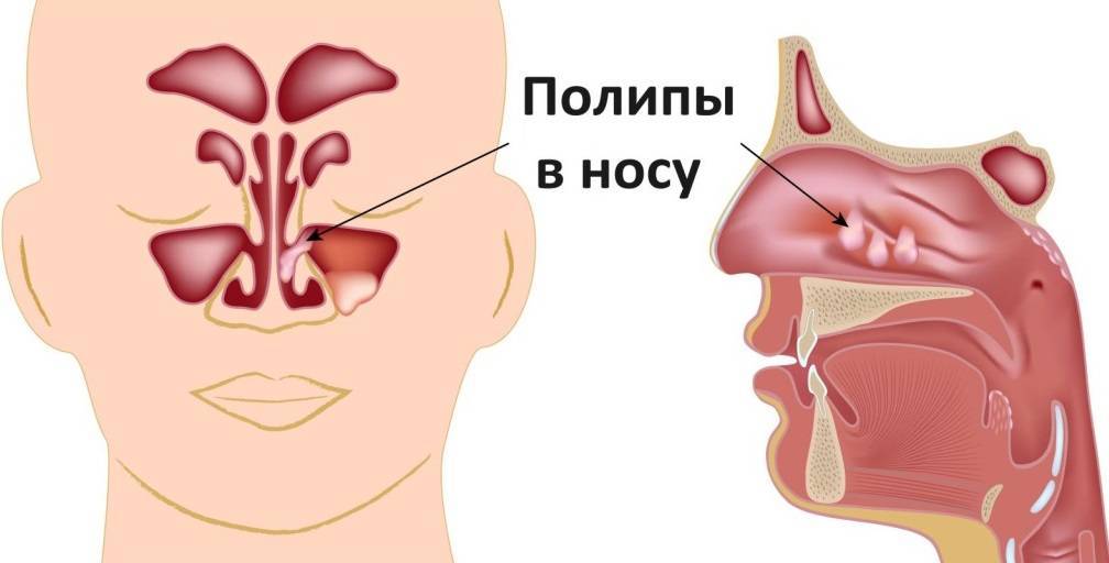 Причины белых выделений из носа и как их лечить