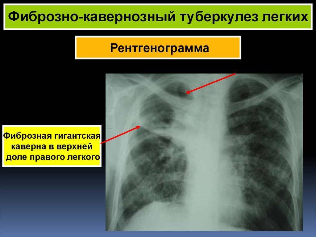 Кавернозный туберкулез легких - симптомы болезни, профилактика и лечение кавернозного туберкулеза легких, причины заболевания и его диагностика на eurolab