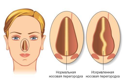 Закупорка (непроходимость) слезного канала у новорожденных