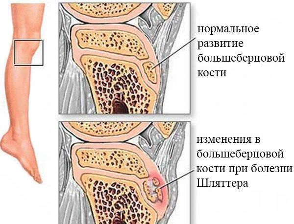 Как лечится болезнь шляттера коленного сустава у детей