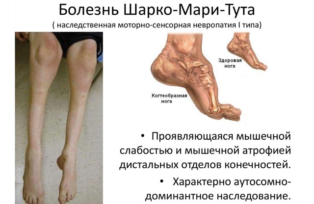 Невральная амиотрофия шарко–мари–тута - описание болезни