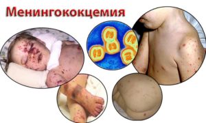 Менингококковая инфекция – симптомы, лечение, прививка и вакцина против менингококковой инфекции
