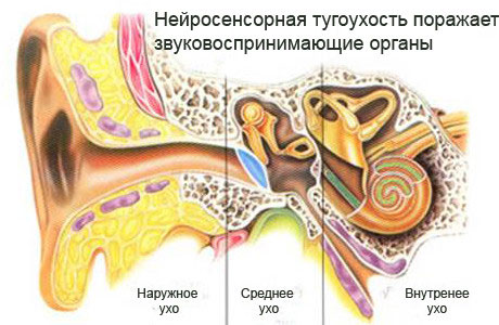Как и чем лечить кохлеарный неврит слухового нерва. нейросенсорная тугоухость (кохлеарный неврит): причины, симптомы и лечение кохлеарный неврит слухового нерва симптомы лечение