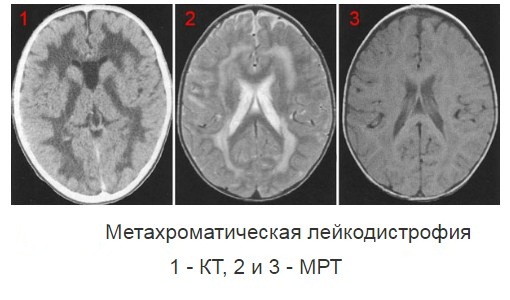 Лейкодистрофии — большая медицинская энциклопедия