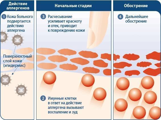 Мази от зуда: список и характеристика самых эффективных препаратов