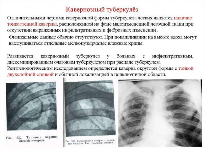 Очаговая форма туберкулеза легких