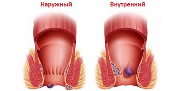 Чешется выше заднего прохода. зуд после дефекации. вероятные причины появления зуда рядом с анусом