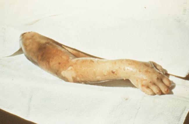Streptococcus mitis (стрептококк митис): особенности, диагностика, лечение