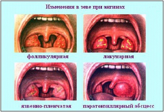 Паратонзиллярный абсцесс