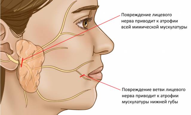 Паралич лицевого нерва симптомы и лечение