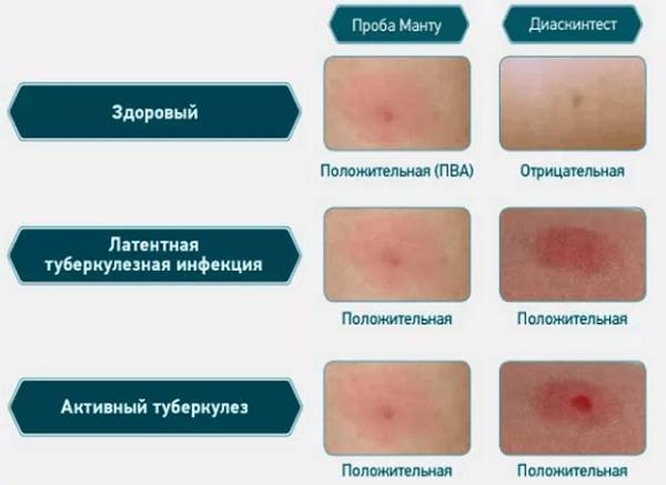 Что значит плохая реакция манту у ребёнка, стоит ли паниковать?