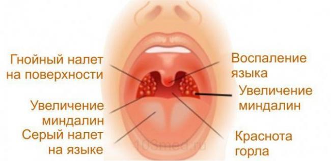 Абсцессы в лор-практике: паратонзиллярный, горла, о флегмонах, лечение