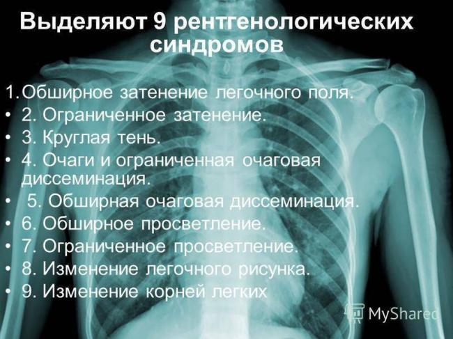 Инфильтративный туберкулез легких — что это такое, заразен или нет, фазы и лечение