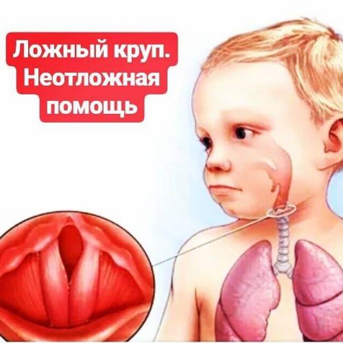 Круп у детей – симптомы и лечение, первая помощь при крупе у детей