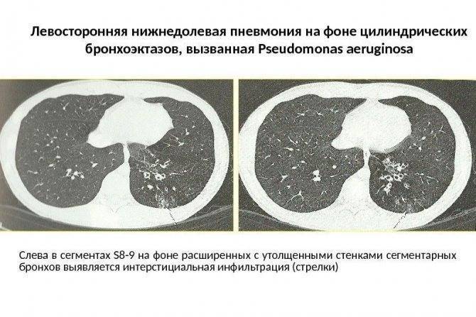Правосторонняя пневмония у ребенка