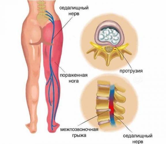 Массаж при ишиасе седалищного нерва: виды, техника выполнения, польза
