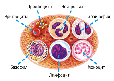 Миеломная болезнь костей