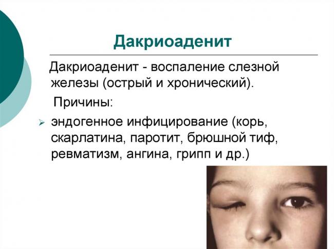 Дакриоаденит
