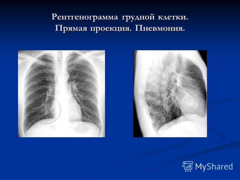 Абсцесс легкого (абсцедирующая пневмония)
