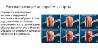 Аневризма брюшной аорты. причины, симптомы, признаки, диагностика и лечение патологии