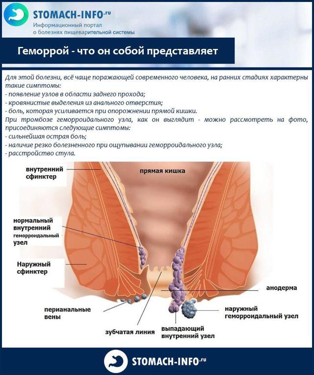 Боль в заднем проходе - причины, характер, лечение. причины и возможные заболевания вызывающие зуд в заднем проходе после опорожнения кишечника — диагностика, лечение и профилактика