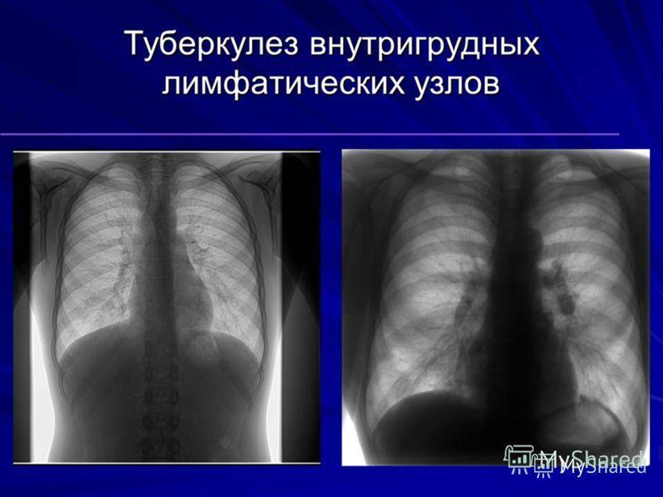 Туберкулез лимфоузлов