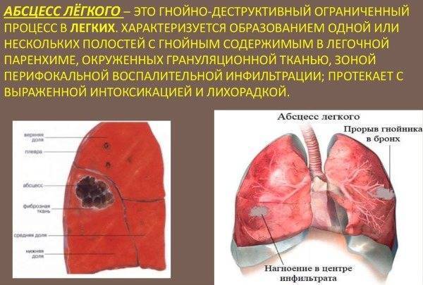 Мокрота с кровью – что это может быть