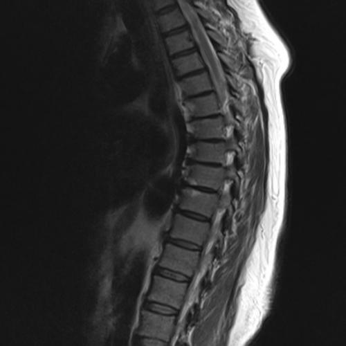 Артериовенозная фистула - dural arteriovenous fistula - qwe.wiki