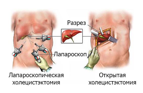 Желчнокаменная болезнь -симптомы и способы лечения