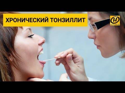 Как вылечить хронический тонзиллит в домашних условиях
