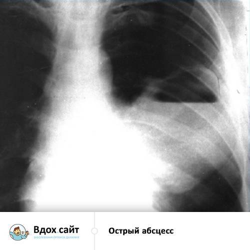 Абсцедирующая пневмония